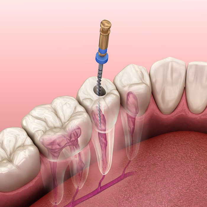 بخش-تخصصی-درمان-ریشه-دندان